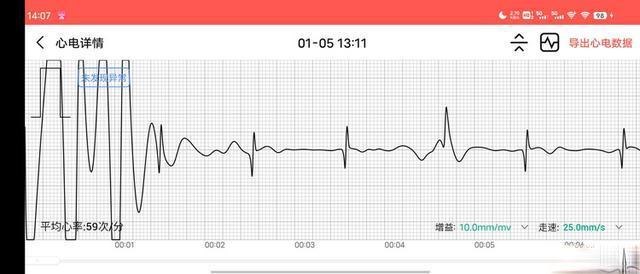 智能手表ECG功能的准确性与局限：能否替代医院检查？