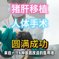 全球首例！猪肝移植人体成功。