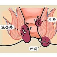 痔疮肉球可以自愈吗？痔疮的三种类型，教你如何自救！